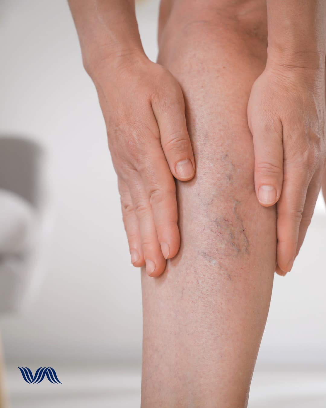 Deep Vein Thrombosis