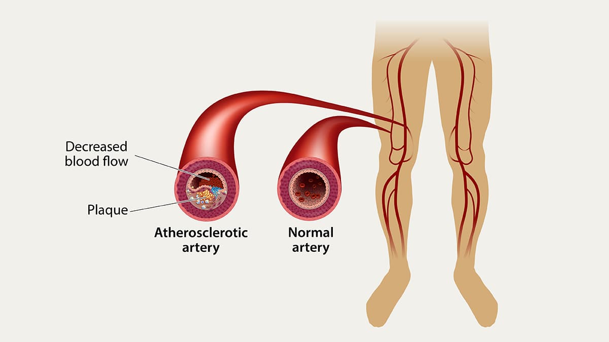 Peripheral Angioplasty