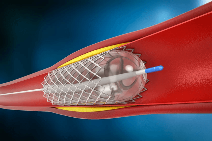 Peripheral Angioplasty
