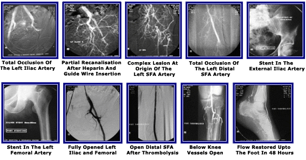 45-Year-Old Male – Total Right Iliac Occlusion