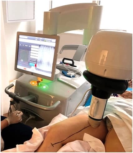 HIFU vein treatment