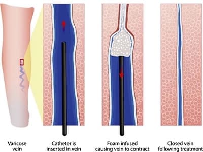 Foam injection via catheter