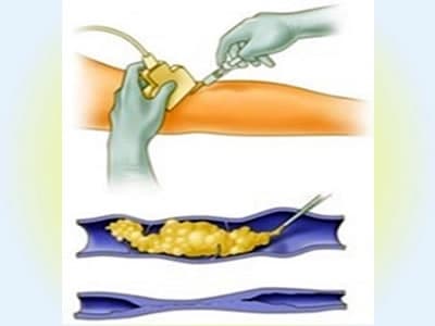 Foam injection directly into the vein