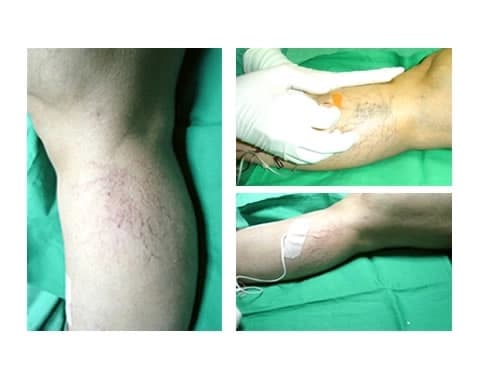 Treatment of spider veins using liquid sclerosant