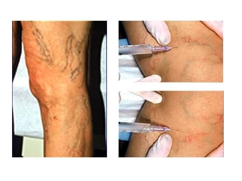 Endothelial damage and fibrosis causing spider vein closure