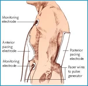 Transcutaneous Pacing