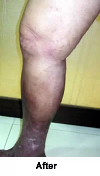 Chronic Ulcer Successfully Healed after treatment