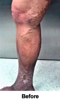 Chronic Ulcer Successfully Healed before treatment
