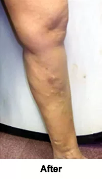 10-Year Varicose Veins Eliminated after treatment