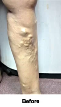 10-Year Varicose Veins Eliminated before treatment