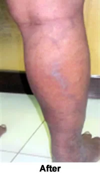 Pain & Pigmentation Resolved after treatment