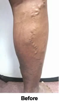 Pain & Pigmentation Resolved before treatment