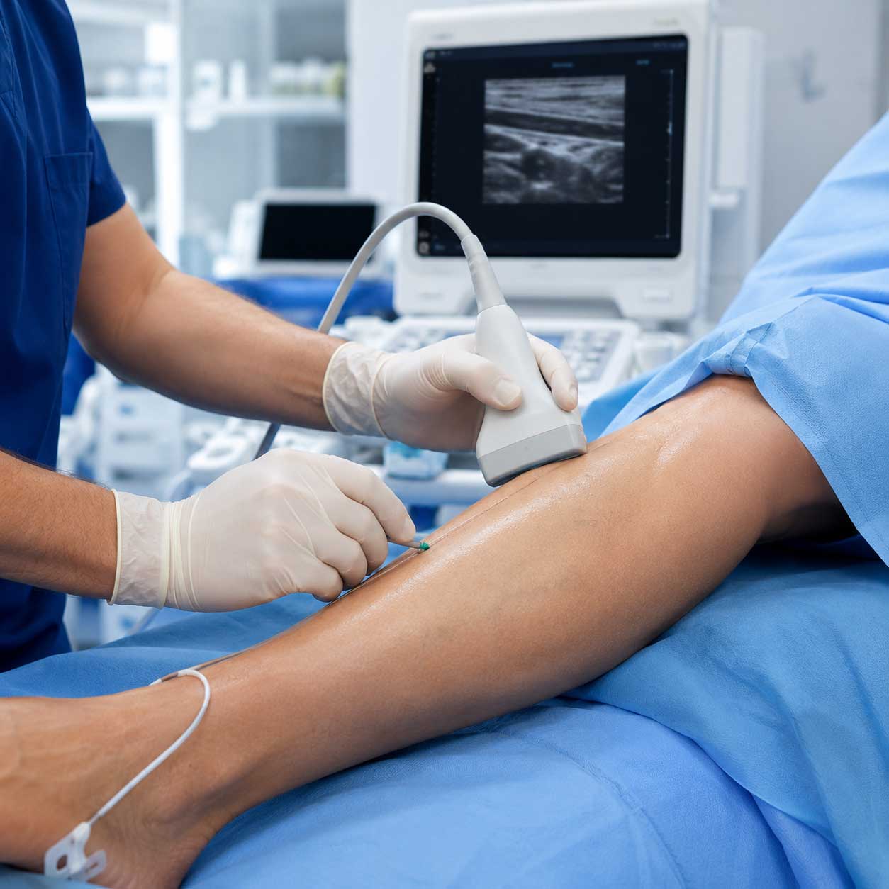 Great Saphenous Veins