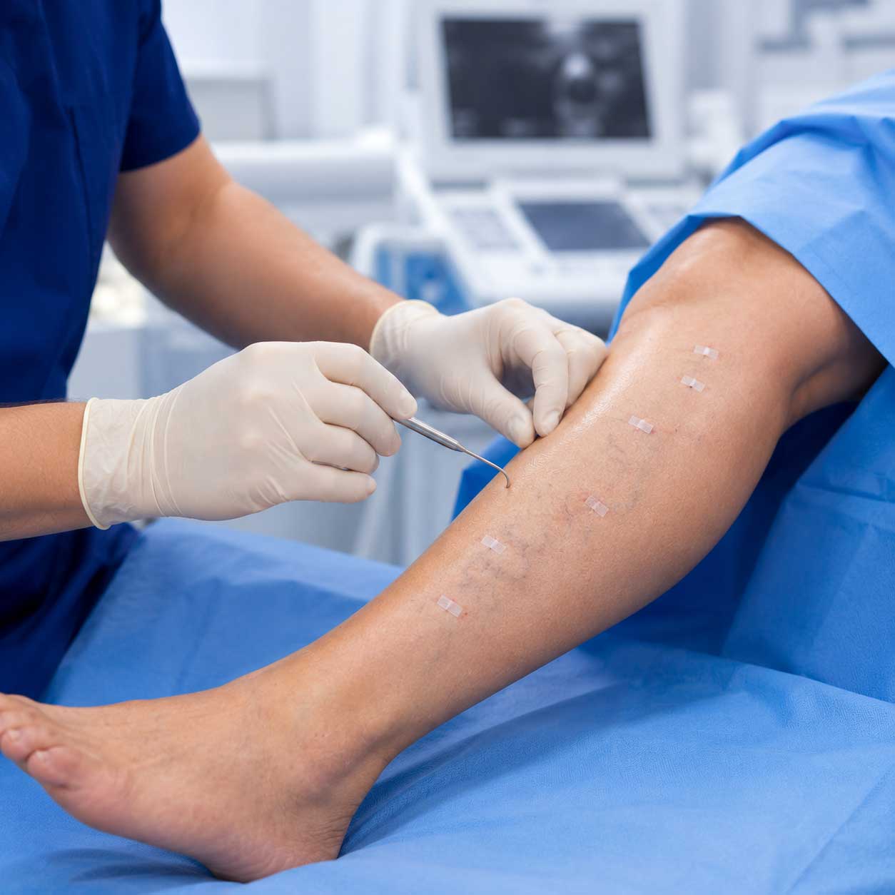 Lateral Varicose Veins