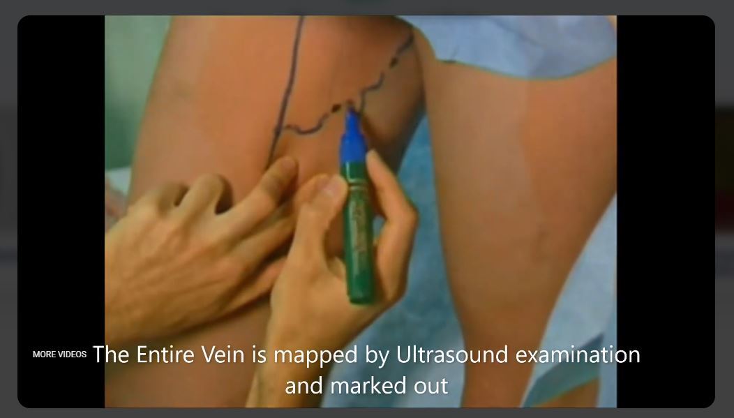 Varicose Veins Methods of Treatment