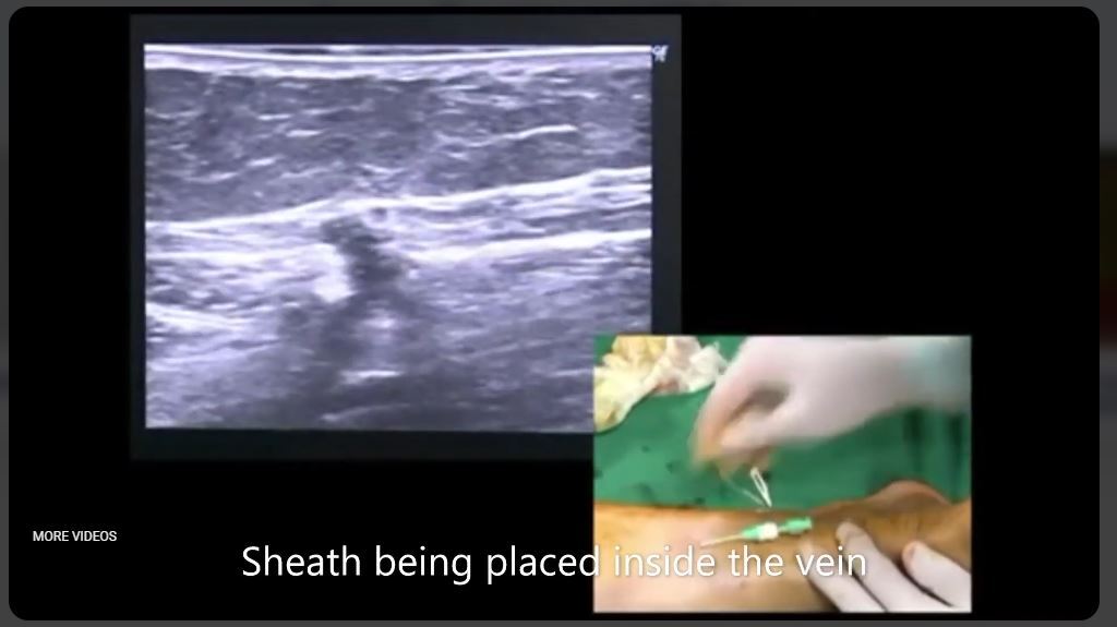 Laser Treatment of Varicose Veins
